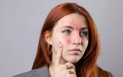 Ex Vivo Tissue Models for Atopic Dermatitis and Psoriasis