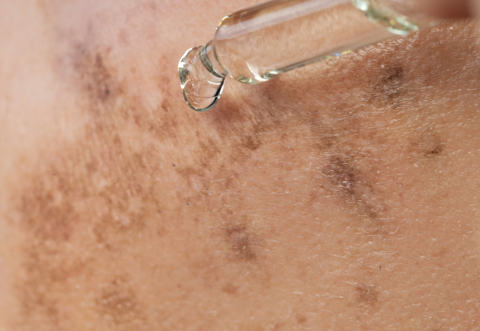 Melanin Inhibition Testing for Dermal Hyperpigmentation