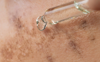 Melanin Inhibition Testing for Dermal Hyperpigmentation