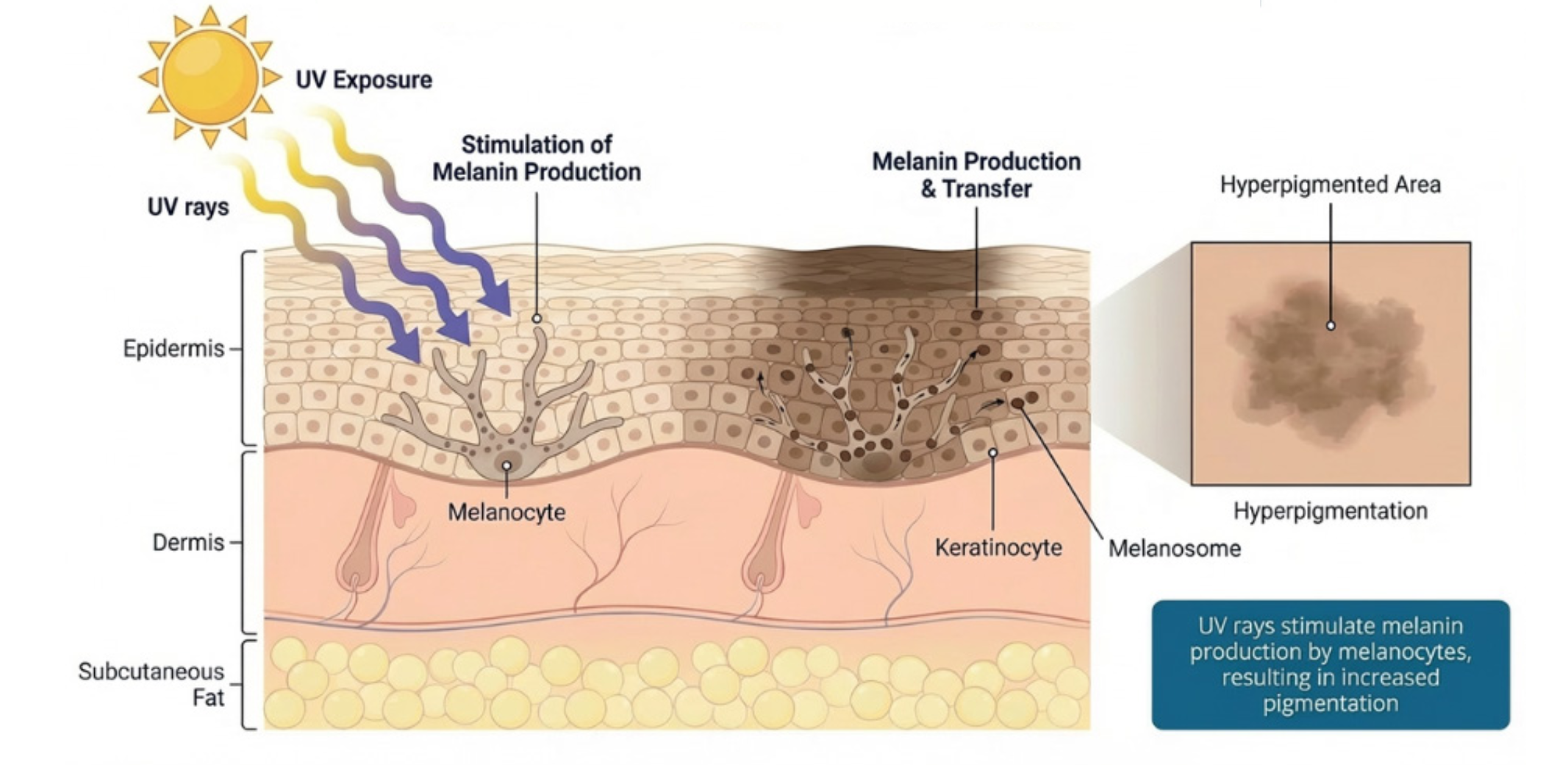 Diagram demonstrating UV induced melanogenesis